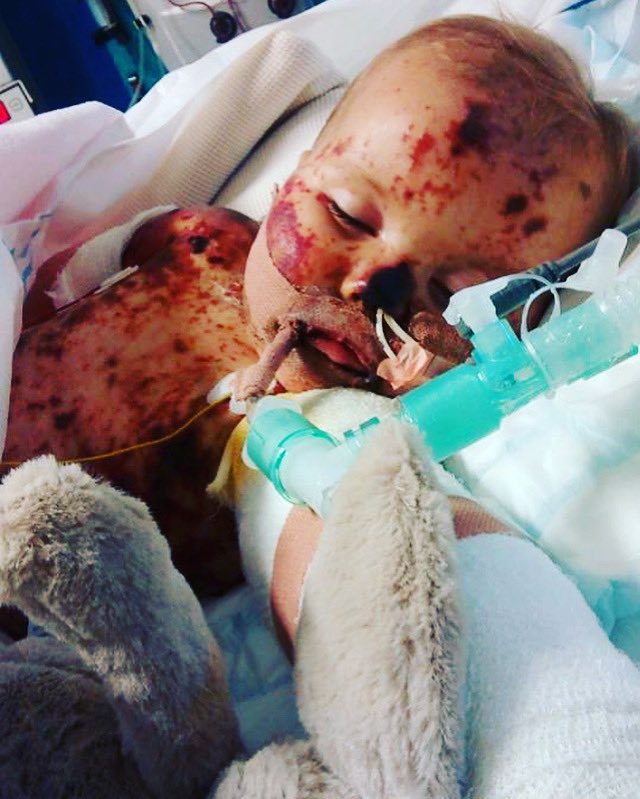 Hope4Harmonie's tweet photo. 🛑Yesterday was World Sepsis Day🛑 
Take a look at our post on Insta - https://t.co/uRajOP0NYQ 

We really are the lucky ones, septicaemia was the result of the meningococcus bacteria that Harmonie contracted and meningitis and sepsis often can come together #SepsisAwarenessMonth https://t.co/gGJq28FdYF