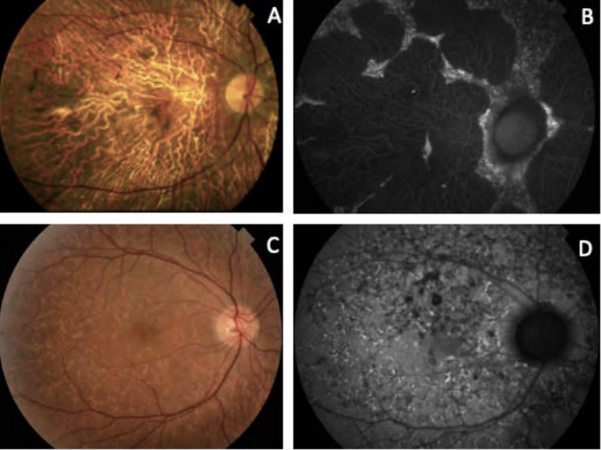 RetinaSERV's tweet photo. Más de 175 mutaciones patógenas en el gen Peripherin-2 están relacionadas con diversas enfermedades de la retina.
#SERV21 #PRPH2 #retina
https://t.co/Cqst2m4JvE https://t.co/THkbhyIDDv