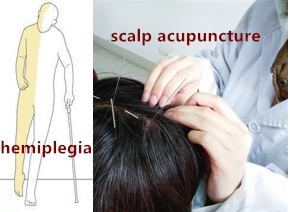 ctnsd_editor's tweet photo. #CTNSD [Study Protocol] Scalp acupuncture twisting manipulation for treatment of hemiplegia after acute ischemic stroke in patients: study protocol for a randomized, parallel, controlled, single-blind trial
#stroke #hemiplegia #scalpacupuncture

https://t.co/l8qcfy6zeB https://t.co/3TuwDB0J7A