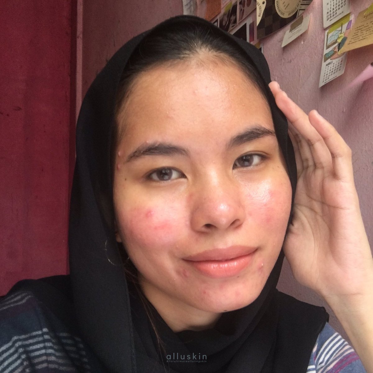 draenskincare's tweet photo. Look at this gorgeous lady! Her skin appears healthier after using alluskin for 3 months.
How about you? Are you experiencing the same goodness?
#alluskinreviews #allureviews #lifewithalluskin https://t.co/kYubk8SxmX