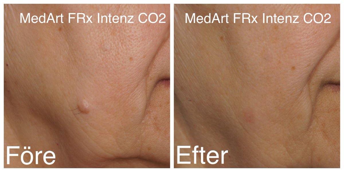 a_medart's tweet photo. Treatment of dermal nevus removed by MedArt FRx Intenz CO2. Only One Treatment. 
MedArt system could support:👍both Ablative and👍Non-Ablative, Surgical and Fractional Treatment. A versatile system, portable and NO consumable. https://t.co/UGp7TxwGIv #moleskine #lasermoleremoval https://t.co/McZ0BmUKvf