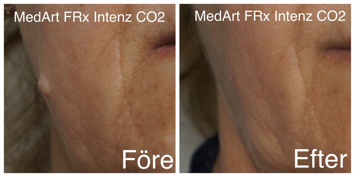 a_medart's tweet photo. Treatment of dermal nevus removed by MedArt FRx Intenz CO2. Only One Treatment. 
MedArt system could support:👍both Ablative and👍Non-Ablative, Surgical and Fractional Treatment. A versatile system, portable and NO consumable. https://t.co/UGp7TxwGIv #moleskine #lasermoleremoval https://t.co/McZ0BmUKvf