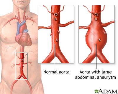 MSHAS_'s tweet photo. *ABDOMINAL AORTIC ANEURYSM (AAA)*

DEFINITION

Dilatation of the abdominal aorta of ≥3 cm or ≥150% (1.5 times) the normal diameter.

Most cases of AAA are infrarenal or juxtarenal.

/1 https://t.co/ilNl1Aq837