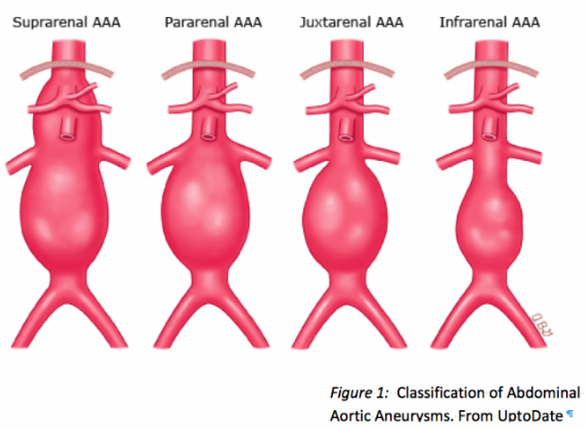 MSHAS_'s tweet photo. *ABDOMINAL AORTIC ANEURYSM (AAA)*

DEFINITION

Dilatation of the abdominal aorta of ≥3 cm or ≥150% (1.5 times) the normal diameter.

Most cases of AAA are infrarenal or juxtarenal.

/1 https://t.co/ilNl1Aq837
