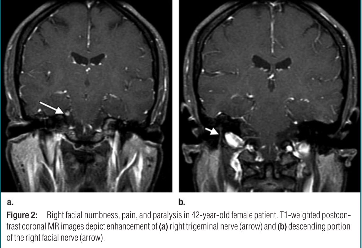 Neuro-Lyme Disease: MR Imaging Findings In cases of nerve-root or meningeal enhancement, Lyme disease should be considered in the differential diagnosis in the proper clinical setting https://pubs.rsna.org/doi/10.1148/radiol.2531081103?url_ver=Z39.88-2003&rfr_id=ori:rid:crossref.org&rfr_dat=cr_pub%20%200pubmed