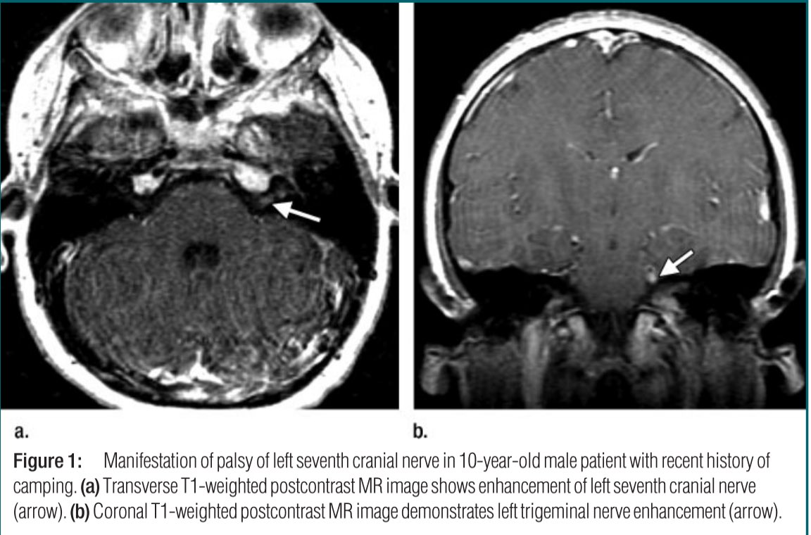 Neuro-Lyme Disease: MR Imaging Findings In cases of nerve-root or meningeal enhancement, Lyme disease should be considered in the differential diagnosis in the proper clinical setting https://pubs.rsna.org/doi/10.1148/radiol.2531081103?url_ver=Z39.88-2003&rfr_id=ori:rid:crossref.org&rfr_dat=cr_pub%20%200pubmed