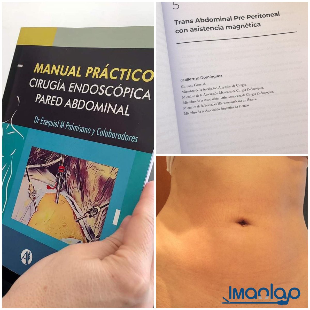 imanlap's tweet photo. La cirugía de Hernia Inguinal usando Imanes reduce incisiones quedando el paciente sin heridas visibles https://t.co/YQrJ1Rm7Eq
