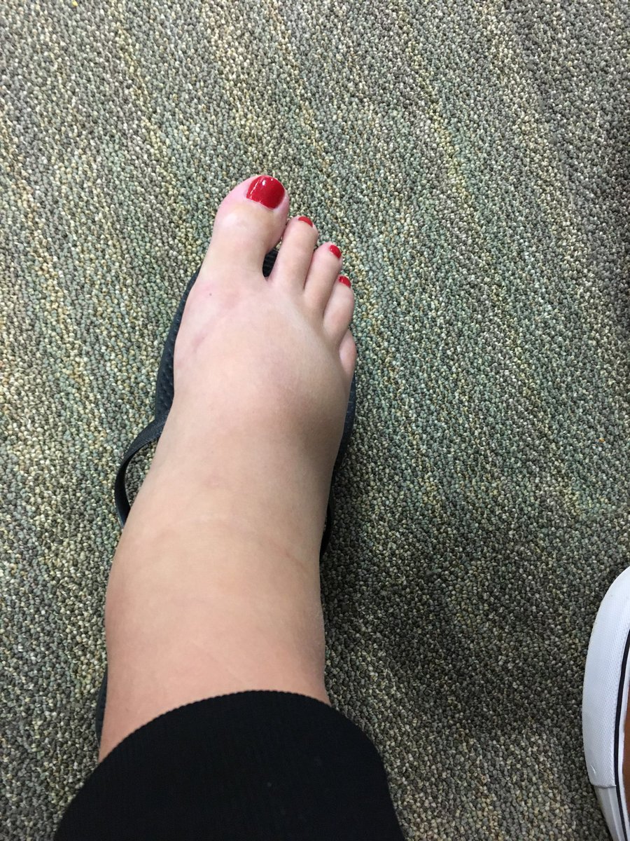 AmandaJambor's tweet photo. @MeghanMcCain So this absurdity happened days after giving birth. 😳I used epsom salt soaks to rediscover my ankles. You will figure out there are so many things your friends did not warn you about! https://t.co/32oLFM4ror