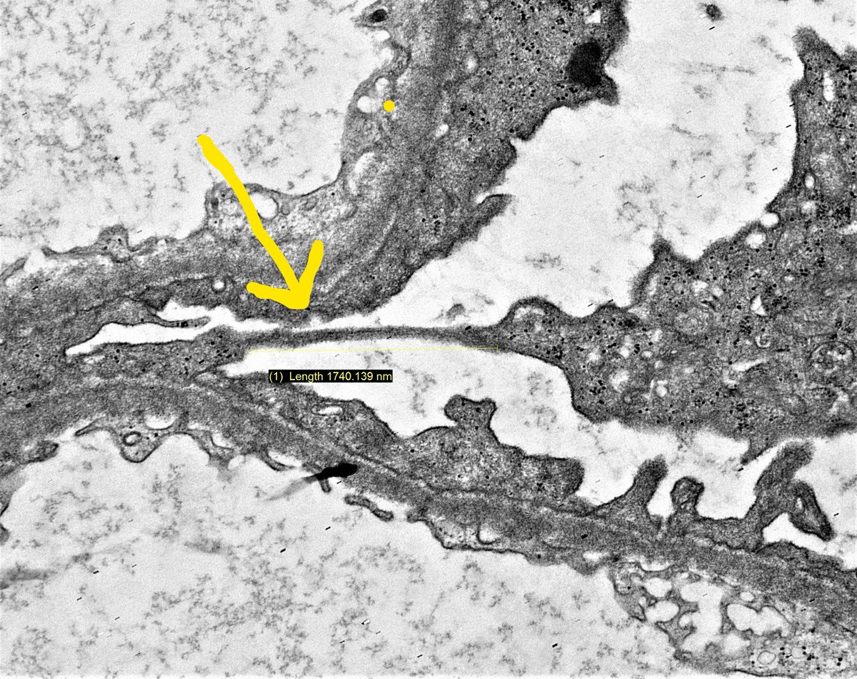 draalok's tweet photo. "Hanging by a thread"....stretched podocyte foot process  with cell body on brink of detachment from GBM, to be eventually excreted in urine. Biopsy from a 4 yr child with FSGS #podocyturia #renalpath #podocytopathy #PathTwitter #FSGS https://t.co/f4DrBEINdW