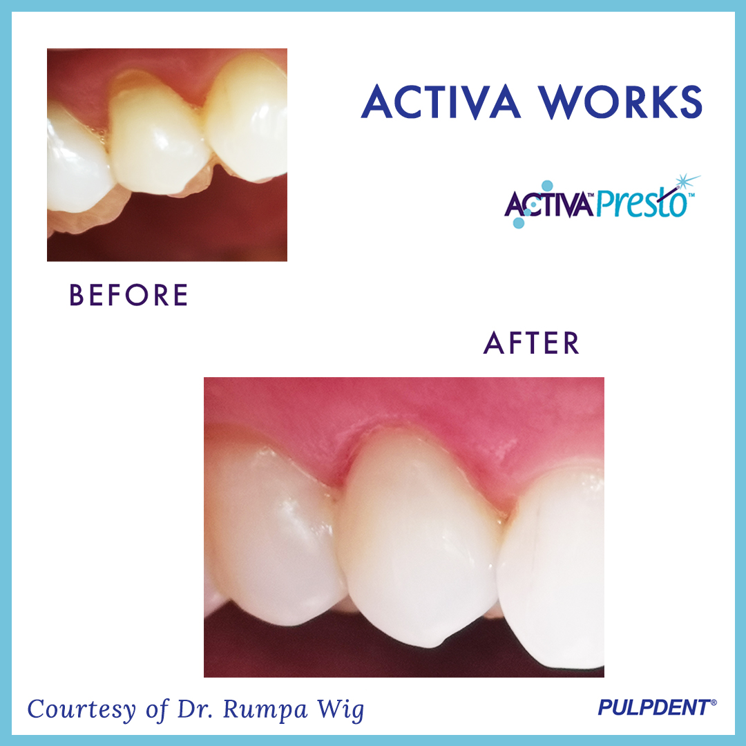 PulpdenTweets's tweet photo. Dr. Rumpa Wig shared these clinical images w/ us after using #ACTIVAPresto for this Class V Restoration 🦷✔️ Email your case images to 📧: feedback@pulpdent.com #ACTIVAWORKS #Pulpdent #PulpdentCorporation #DentalAssistant #Dental  #DentalHygienist  #DentalPhotography https://t.co/0wyyVVEehm