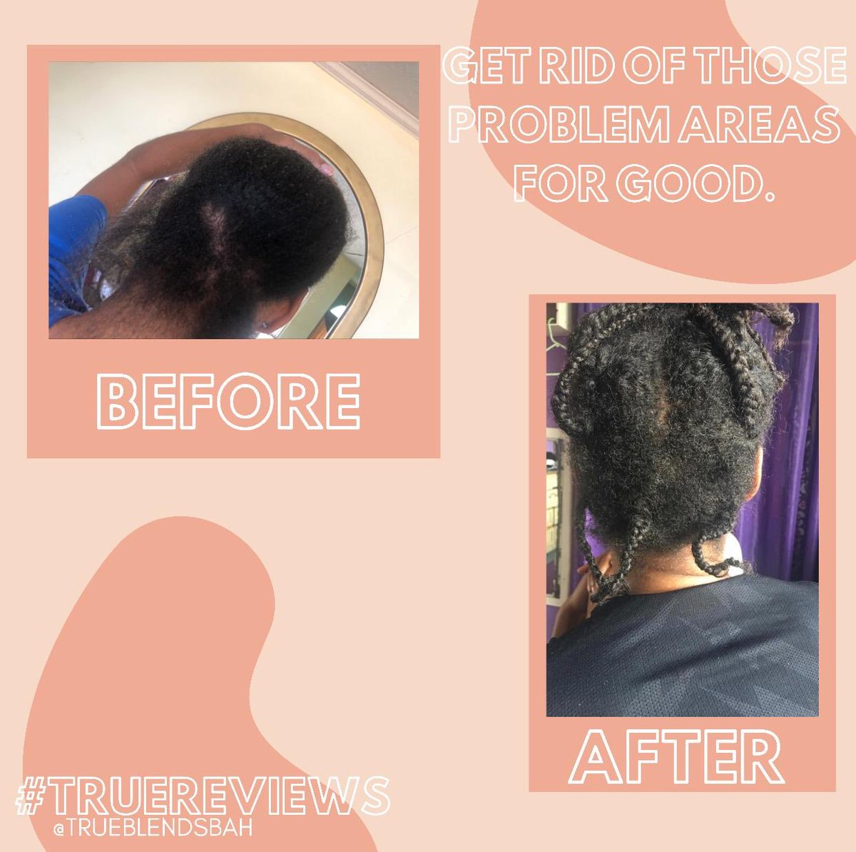 trueblendsbah's tweet photo. #TRUEREVIEWS : For years #TrueBlends ‘ Alexis has struggled with breakage, thinning and bald spots due to a mild case of alopecia. When dermatologist visits and medication didn’t work, a consistent #TrueBlends hair care regime came to save the day with slow but sure progress. https://t.co/dPpBVVKHXI