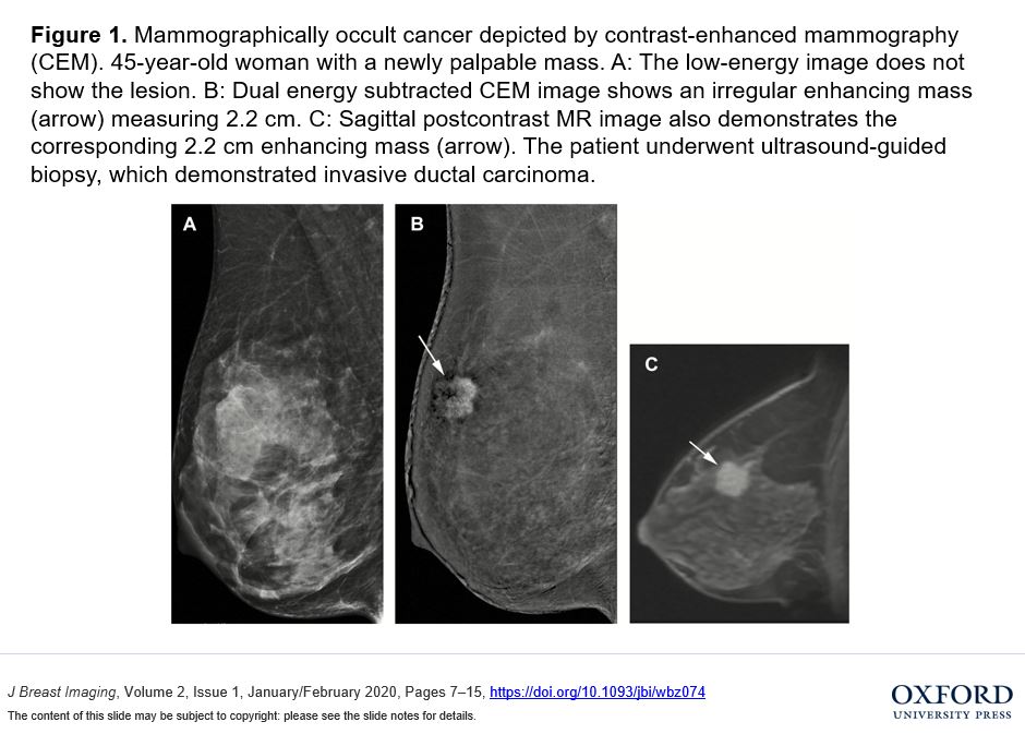 JBI_SBI's tweet photo. #JBI- Insights and Input on Contrast Enhanced Mammography: https://t.co/Ax0c1fE47q https://t.co/TewNblsciE