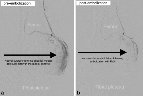 Genicular Artery Embolization to Improve Pain and Function in Early-Stage Knee Osteoarthritis—24-Month Pilot Study Results | ow.ly/7SCq50BgwnZ #irad