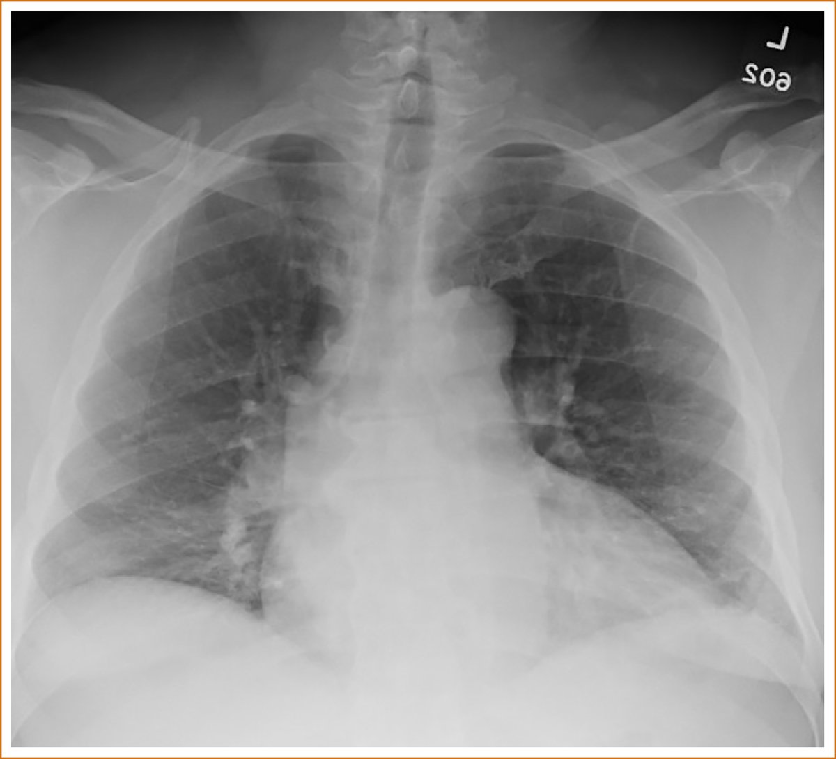 ARTICLE IN PRESS
"Cough to Dyspnea to Acute Respiratory Distress Syndrome" by Jiwani and Rehana.

amjmedsci.org/article/S0002-…