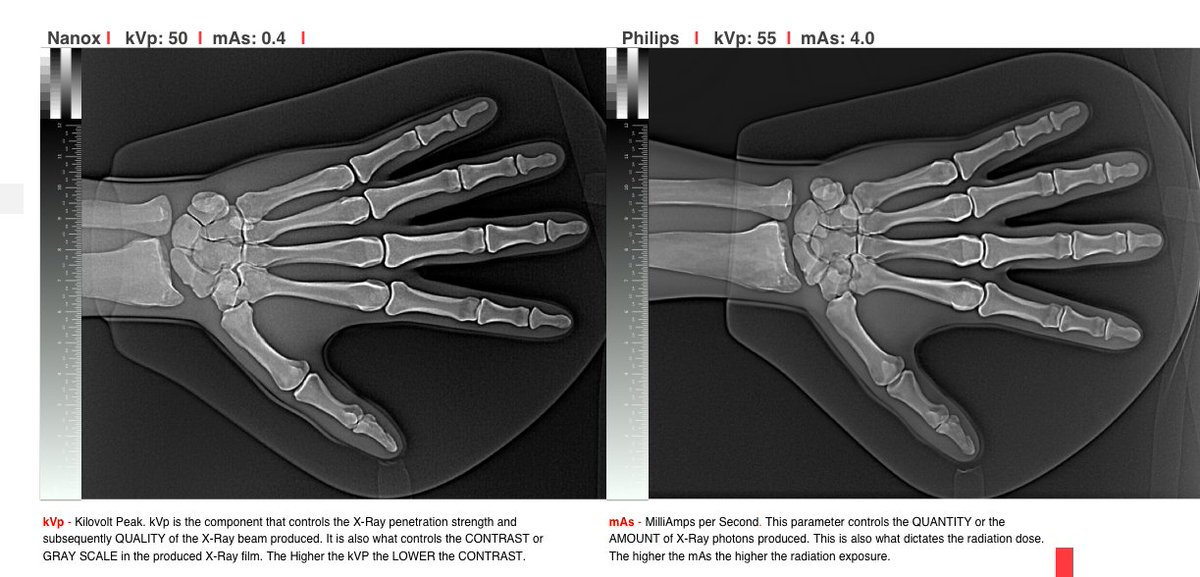 JohnNosta's tweet photo. A closer look at Nanox imagine quality vs. conventional (and antiquated) x-ray tech. @NanoxVision #disruption #radiology #imaging $NNOX #digitalhealth #healthtech https://t.co/QxAkdEAUBg
