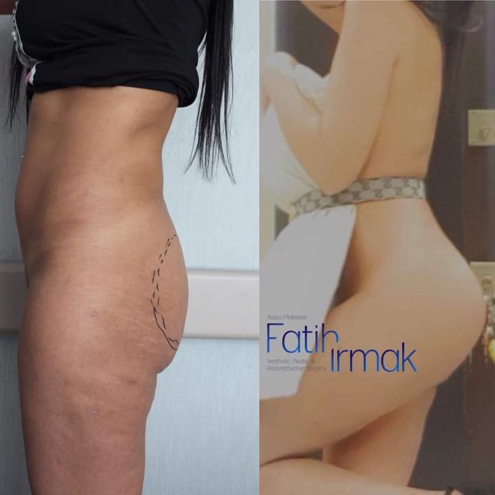 drfatihirmak's tweet photo. 4 years later result of #buttockaugmentation with #buttimplant.
Thanks to my lovely patient for her great post 🤗 https://t.co/fSKBEe6QFL