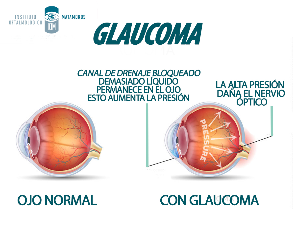 iom_ec's tweet photo. 👨🏻‍⚕️ La tecnología actual nos permite manejar adecuadamente el glaucoma para tener un control preciso de la presión ocular, evitando la ceguera en nuestros pacientes. https://t.co/uzjrr9dIPh 👁 https://t.co/nSSxAAQpAs