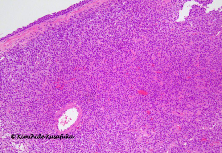 KusafukaK's tweet photo. 70’s Japanese Female, nasal cavity
Nose Bleeding. What’s your diagnosis? #ENTpath, #surgpathol #entpath https://t.co/vIxGul80PV