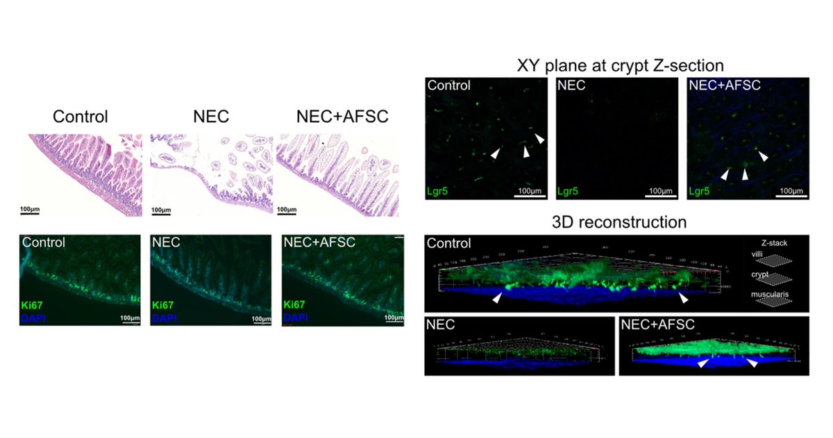 Scientists from the University of Toronto (<a href="/UofT/">University of Toronto</a>) have demonstrated that #AmnioticFluid stem cells and extracellular vesicles attenuated necrotizing enterocolitis intestinal injury by activating the Wnt signaling pathway. 🔬 
go.nature.com/3kgl2rz