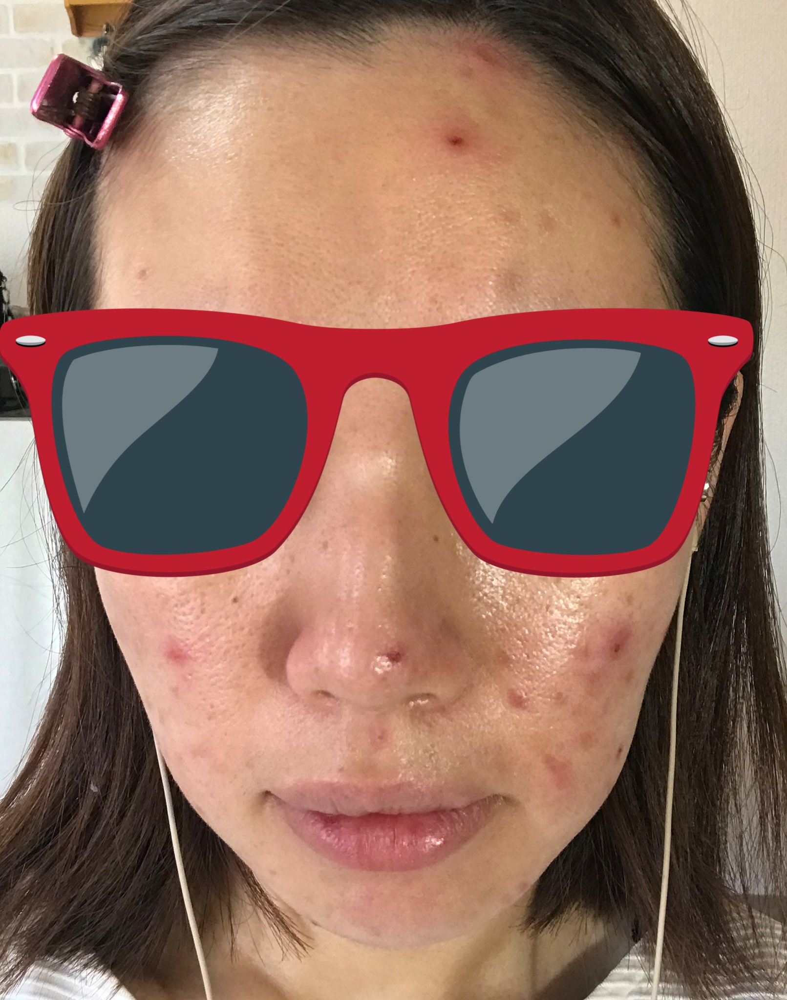とろこ のんびりダイエット 閲覧注意 ニキビや肌荒れでつらい人に私の顔を見て欲しい 夏 生理前の肌荒れは死にたくなるくらいに辛い 保湿しても 薬飲んでも 枕カバー変えてもこれ でもメイクでここまでは隠せる だから 肌が汚いのにメイク