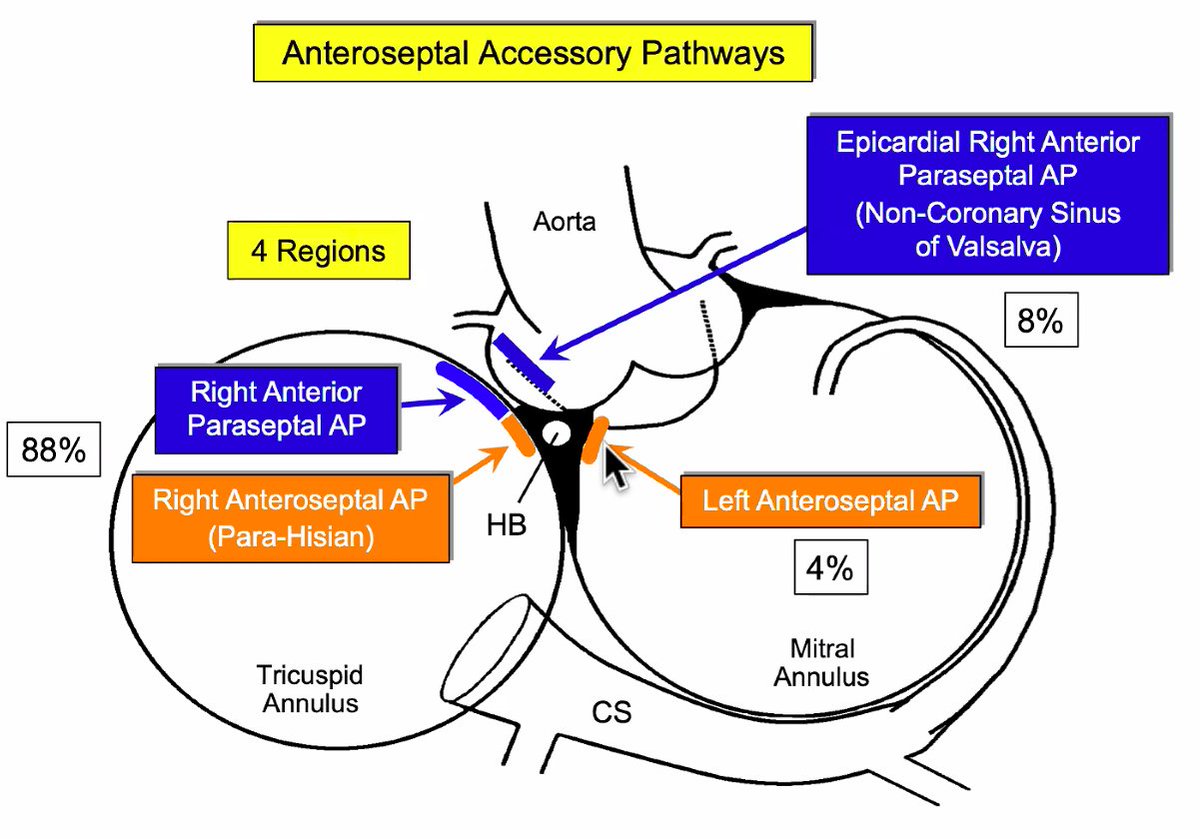 Anteroseptal APs by Sonny Jackman 12.9.2020
Four regions above HB
AS-APs can be easily “bumped”. 
Use parahisian pacing.
Pace multiple A and V sites to produce longest AV or VA interval.
#EPeeps #Cardiology #ECG #ablateAP