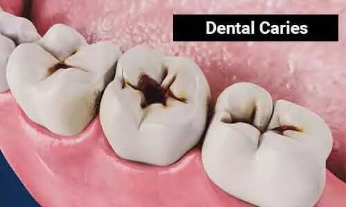Guys I want to tell you about this kind of cavities... The ones with fractures (holes) and painful... [A thread]