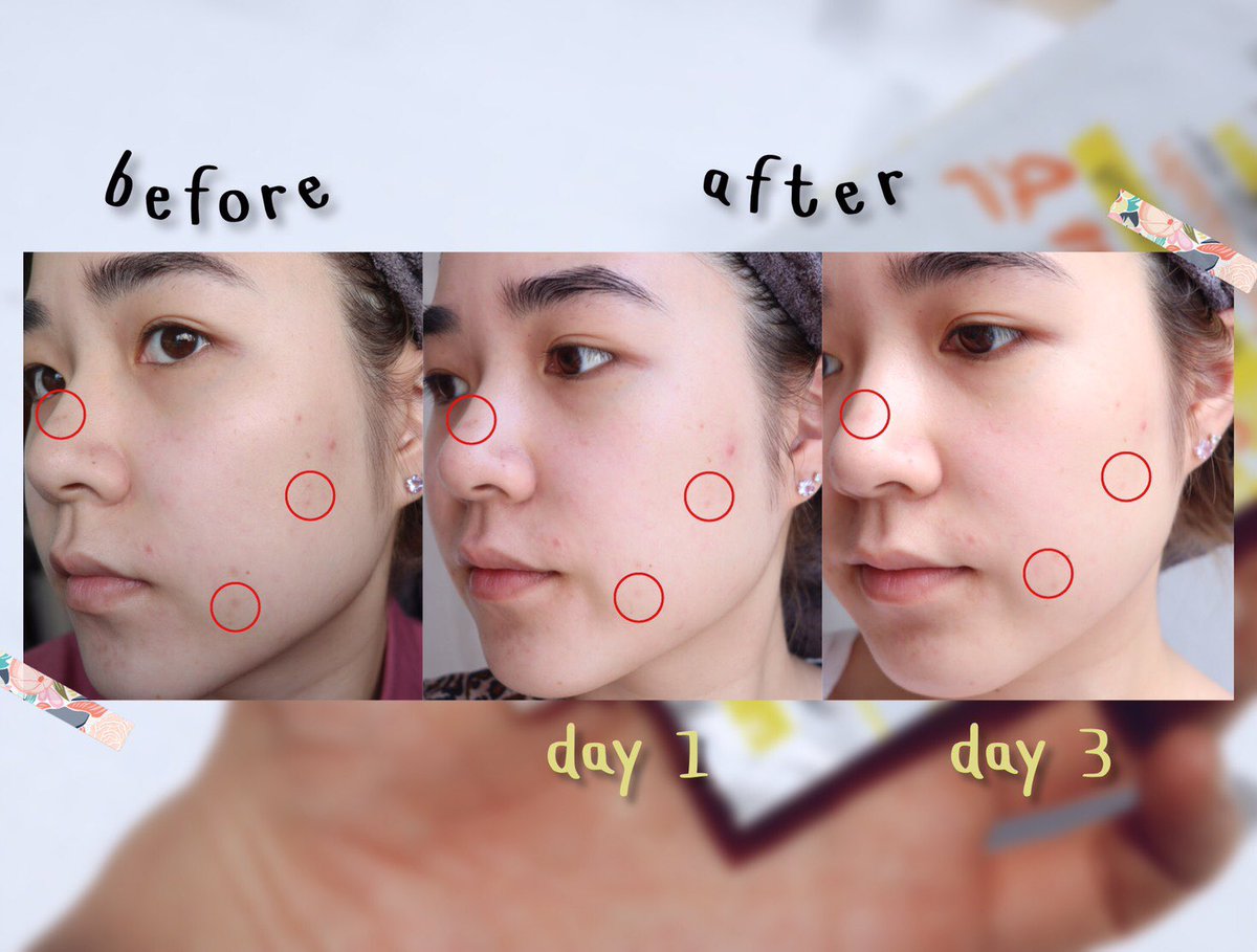 nninitecha's tweet photo. เพิ่งได้ลอง เซรั่มตัวใหม่ของ Garnier ไปเจอมาใน 7-11 เนื้อดีมากทั้ง 3 สูตรเลย ไม่เหนียว ชุ่มชื้น ทาง่าย แต่นี่ชอบสูตร Vit C สุด เพราะวิตวีเข้มข้นมากแม่ ใช้แล้วหน้ากระจ่างใสขึ้นจริง ผิวดูเนียนๆด้วย รอยสิวรอยดำก็จางลง นี่เพิ่ง 3 วันเองอ่ะแม่ !!! ไม่มีไม่ได้ป้ะ #GarnierBoosterSerum https://t.co/NEG4UFOyKO