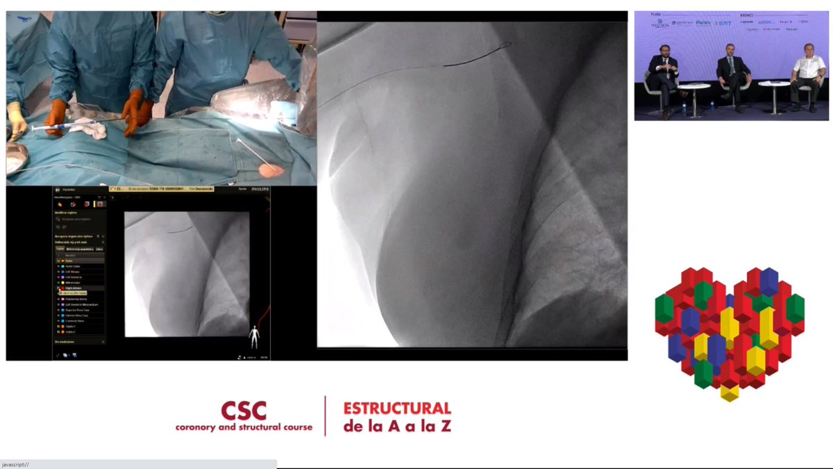 rafavidalperez's tweet photo. Siguiendo #CSCstructural desde casa. Ahora un interesante caso de cierre de orejuela del Hospital de Salamanca @icruzgonzalez . El papel de la guía mediante ETE explicado por @manuelbarreirop https://t.co/UBv7Qlxtqd