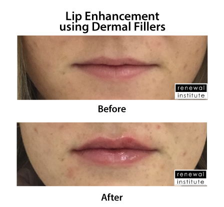 SkinBodyRenewal's tweet photo. Do you struggle with thin lips? Give your lips a little added volume and shape with injectables. No downtime and impressive results. Get all the info here https://t.co/TJMYKZMDJn
#SkinRenewalSA #lips #lipenhancement #thinlips #injectables #lipvolume #LusciousLips https://t.co/B7RA4vAjvh
