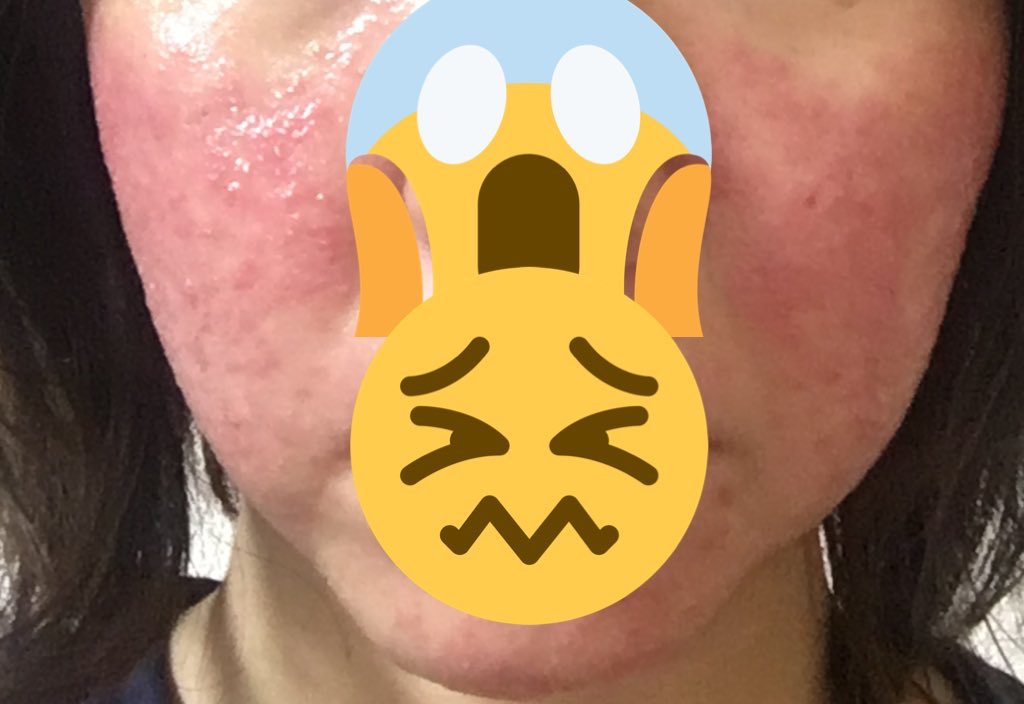 モヨチコ 酒さ様皮膚炎治療中 Datsusutemoyo Twitter