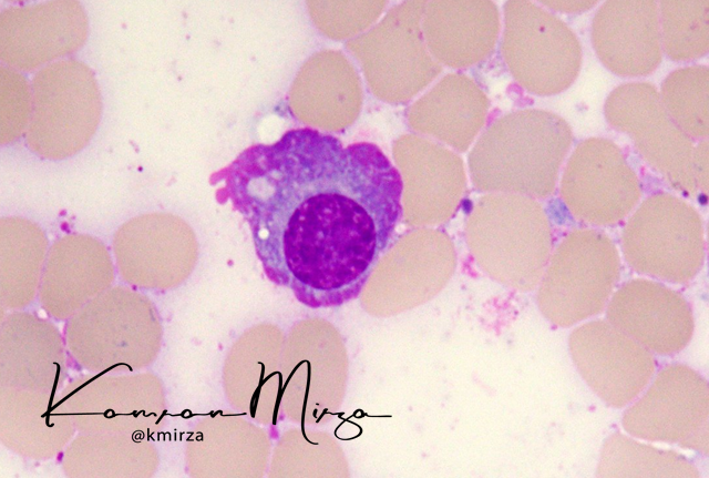 KMirza's tweet photo. You know that you're a #hemepath nerd when you get abnormally excited when you see this little guy #mmsm #IgA Check out https://t.co/XSkNjXnF3W for more pictures of #FlameCells https://t.co/w6Ir9zdk1K