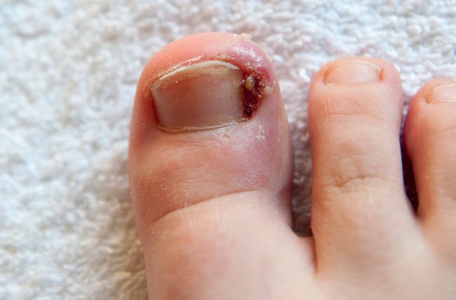 _drirma's tweet photo. HOW TO TREAT CAGU/CENGKAM

Cagu or sometimes kita refer sebagai cengkam adalah situasi apabila kuku tumbuh ke sisi dan menekan isi di tepi jari. This thread terbahagi kepada punca, rawatan dan cara untuk cegah cagu.

THREAD https://t.co/Lb77dLyhYm