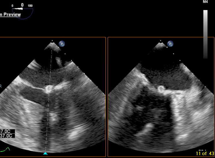 Post your answers! Challenge of the Week: TEE

50 F w a h/o ESRD presenting for TEE to evaluate an abnormal mitral finding.  She has no reported infectious symptoms.  What’s the diagnosis and what’s the typical management?  

drive.google.com/file/d/1SDW6g-…

drive.google.com/file/d/1YTBOW6…