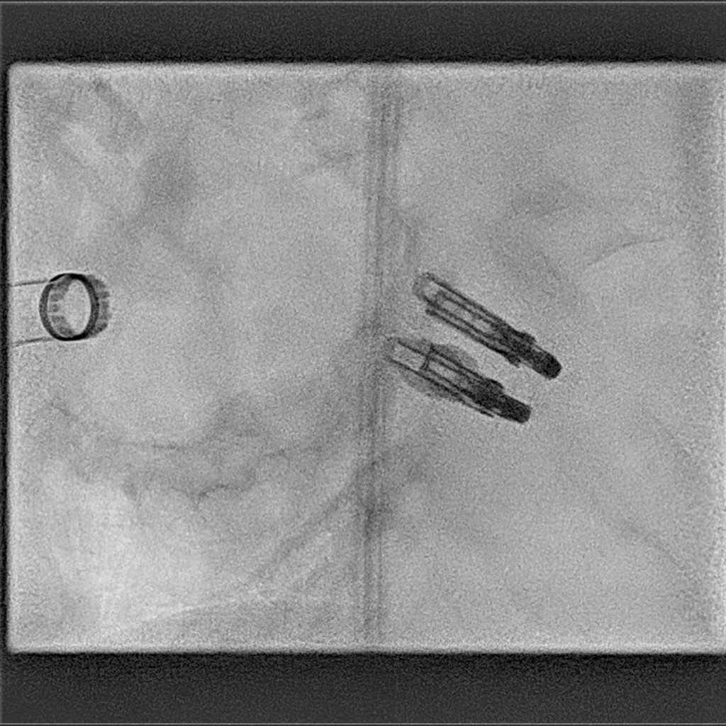 vonBardelebenRS's tweet photo. #abbott #g4 #1stimplant_Europe #Herzklappenzentrum_Mainz #Heartvalvecenter_Mainz #mitralvalve #TMVr #newoptions #PrimaryMR
On September 15th the first patients with FMR and DMR and P2 flail were treated successfully at the #HVC in #Mainz. Great results, flail leaflet to trace MR https://t.co/yhcERxgyoB