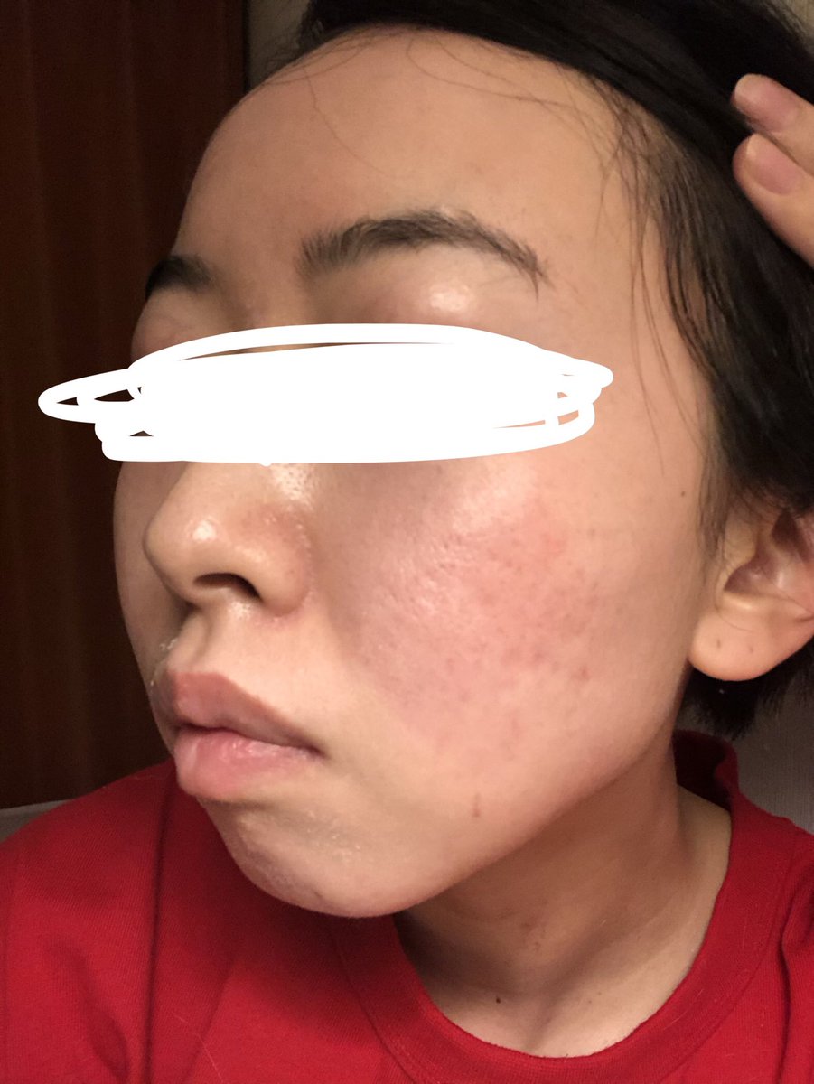 はち ゼオスキン ダーマペン リベ大 ゼオスキン64日目の夜 剥けてたところがお風呂入ったらつるり 両頬のクレーター 色素沈着 ニキビ跡 気になるなぁ 綺麗になりたい