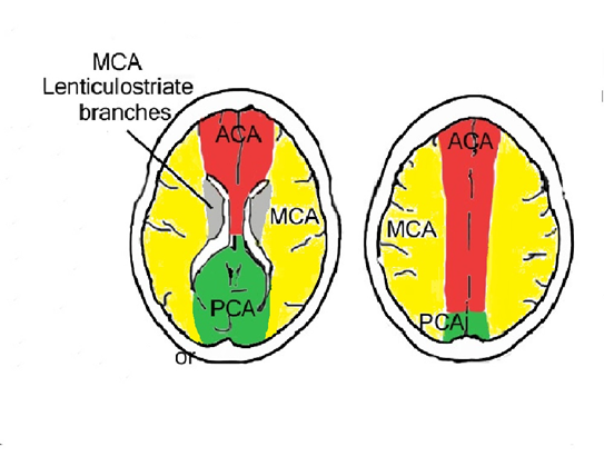 1/ Reminder of topography: MCA (yellow) and PCA (green) territory. Inferior division MCA (near the borderzone of PCA) involves the occipital lobe