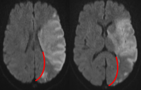 3/ This is an example of a patchy MCA territory infarct. Note that the inferior division MCA affects the partieto-occipital lobe (except for the very medial portion of the occipital lobe, which we already stated is PCA). Red line indicates the borderzone between MCA/PCA