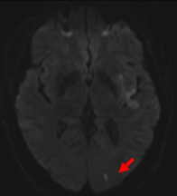 5/ A patient has a small parieto occipital infarct on MRI DWI (arrow) and a high-grade left carotid stenosis. This infarct (arrow) is actually inferior division MCA and the carotid stenosis is symptomatic (There are also other MCA infarcts visible in this case)