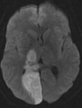 2/ This is an example of a full PCA territory infarct on MRI DWI in a patient with a PCA occlusion. PCA infarct affects the very medial occipital lobe. In a very proximal PCA occlusion, thalamus/midbrain can also be affected.