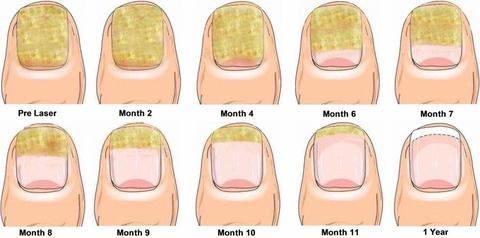 SharonB36823999's tweet photo. A Natural Solution For Nail Fungus: https://t.co/IzlXF0fE5B 

#nailfungus #fungus #feet #footcare #foothealth #toenails #toes #beautytips #Covid_19 #NewYork #LosAngeles #Texas #ThursdayMotivation #ThursdayThoughts #thursdaymorning #Deals #summer #nails #cure #remedy #medication https://t.co/YowMsHjJ0v
