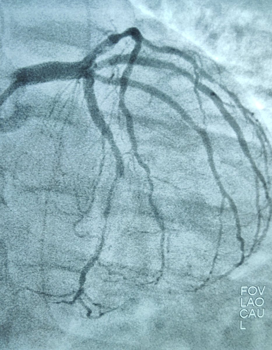 nicolasamabile's tweet photo. Our first NSTEMI case managed according to the new #ESCGuidelines : 1) angio within 24 h 2) no P2Y12 pretreatment 3) tirofiban bolus before PCI 4) Cx/OM1 TAP stenting 5 ) post PCI prasugrel LD . @DFCapodanno @PCRonline @GRCIcardio @mirvatalasnag @SFCardio https://t.co/DczAP1go9J