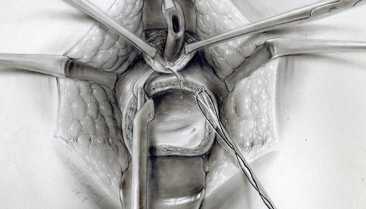 AmerUrological's tweet photo. Here is a Didusch illustration of the use of boomerang needle holder in making anastomosis between bladder &amp; membranous urethra &amp; the Boomerang instrument from granddaughter of Dr. Carlos Amaya who, after Hopkins residency, received it from Hugh Young #TBT #DiduschMuseum https://t.co/RxuqyQEvYq