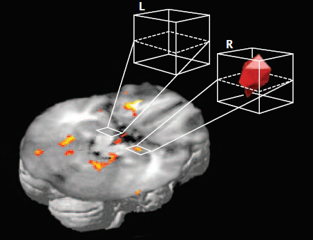 This change was possible thanks to a long list of breakthroughs in the topic such as the description of different patterns of amygdala activation during emotional memory consolidation when comparing men (left) and women (right)