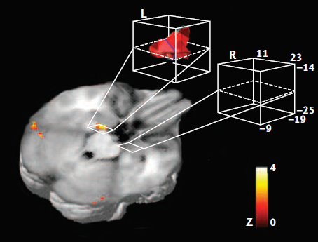This change was possible thanks to a long list of breakthroughs in the topic such as the description of different patterns of amygdala activation during emotional memory consolidation when comparing men (left) and women (right)