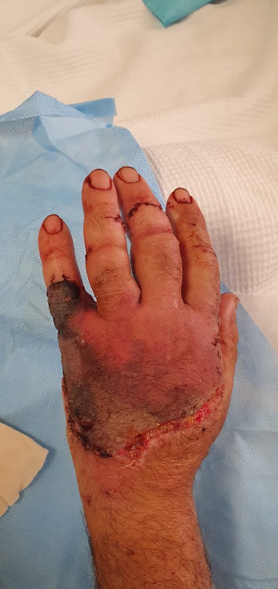 On the day of the explosion, aside from their work in ER they performed several critical and complex hand surgeries, in addition to two blast unrelated emergency cases, one of which was the first to be done in Lebanon, a total microvascular re-implantation of an amputated scalp!