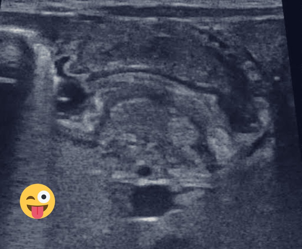 CirugiaPediaMx's tweet photo. Nemotecnia para el #ENARM2020
-Las medidas por ultrasonido que son criterio quirúrgico en la estenosis hipertrófica del píloro son las del Pi (3.1416)

👍🏻Más de 3mm de grosor de la pared
👍🏻Más de 14mm de diámetro
👍🏻Más de 16mm de longitud

#SoMe4PedSurg 👶🏻😛 https://t.co/pEGEM3liGk