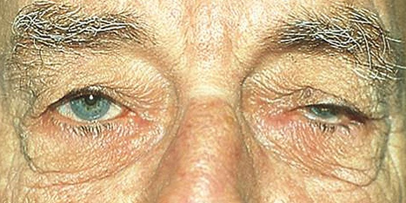 WashEye's tweet photo. The first drug for blepharoptosis (droopy eyes) has gained FDA approval! https://t.co/1sHs2W8CrH https://t.co/vE1VVPIrpW