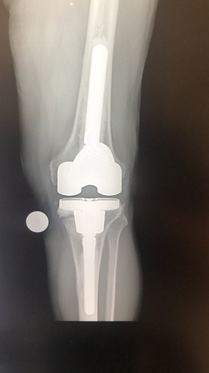 Previous 2-stage exchange. Now with recurrent/persistent infection. Thoughts? Prayers?