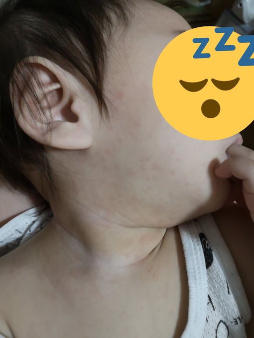 昨日平熱に戻って晩からすげー発疹出てきた
やっぱり突発性発疹だったみたい 