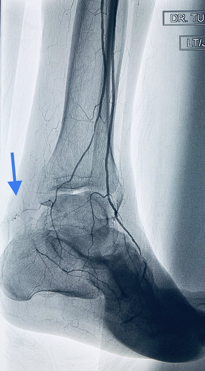 t_intheleadcoat's tweet photo. As a #CLIfigter, there will be clinical successes and failures...failures are equally if not more important than successes to learn and adapt. Time will be a judge of this one👇🏾
Heel ulcer, long PT #CTO, failed antegrade, #pedalloop conduit to cross.@SIRRFS #MedTwitter @CAIRweb https://t.co/SgLswR2yTU